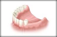 Dental Implants India image 3