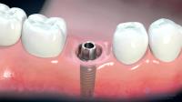 Dental Implants Expert image 4