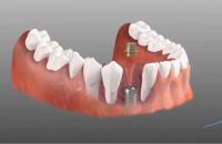 Dental Implant Clinic image 4