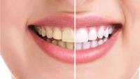 Fresh Teeth Whitening image 1