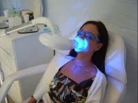 Laser Teeth Whitening Warwick image 1