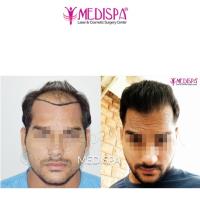 Medispa Hair Transplant Center image 3