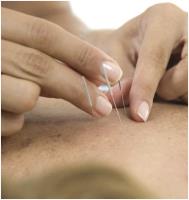 Acupuncture By Sigyta Hart image 3