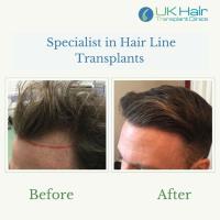 UK Hair Transplant Clinics image 3