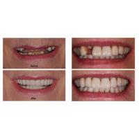 Full Mouth Dental Implants Turkey image 1