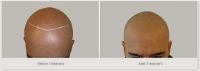 HIS Hair Clinic - Scalp Micropigmentation image 2