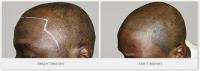 HIS Hair Clinic - Scalp Micropigmentation image 4