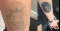 Tattoo Removal Manchester image 1