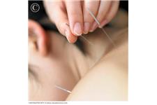 Amanda Suarez Cooper Acupuncture image 2