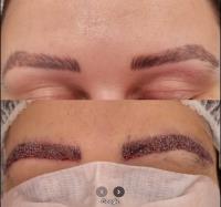 The Brow Lift image 1