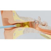 Ear Wax Solution - East Grinstead Ear Wax Clinic image 5