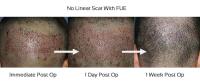 Capital Hair Restoration - Hair Transplant image 5