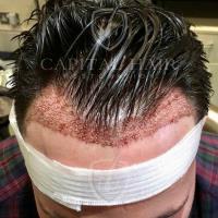 Capital Hair Restoration - Hair Transplant image 3