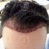 Capital Hair Restoration - Hair Transplant image 4