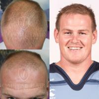 Capital Hair Restoration - Hair Transplant image 7