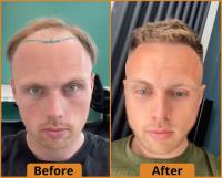 Capital Hair Restoration - Hair Transplant image 9