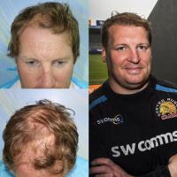 Capital Hair Restoration - Hair Transplant image 2