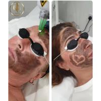 Quantum Laser and Scalp Micropigmentation (SMP) image 3