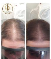 Quantum Laser and Scalp Micropigmentation (SMP) image 4