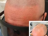 Quantum Laser and Scalp Micropigmentation (SMP) image 10