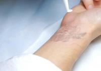 The Tattoo Removal Clinic image 3