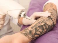 The Tattoo Removal Clinic image 4