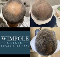 Wimpole Hair Transplant Clinic Brighton image 3