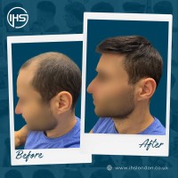 IHS Hair Replacement London image 3