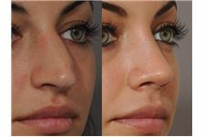 Rhinoplasty UK image 1