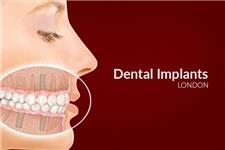 Dental Implants London image 2