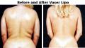 Accredited Vaser Liposelection Clinic in London image 1
