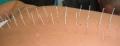 Acupuncture image 3