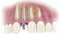 Cosmetic Dentist & Dental Implants Norwich - Dr Ori Michaeli image 3