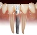 Cosmetic Dentist & Dental Implants Norwich - Dr Ori Michaeli image 5