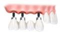Cosmetic Dentist & Dental Implants Norwich - Dr Ori Michaeli image 7