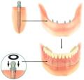 Cosmetic Dentist & Dental Implants Norwich - Dr Ori Michaeli image 8