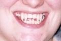 Cosmetic Denture Design, Teeth Whitening and Fangs by Speedy Denture Repairs LTD image 5