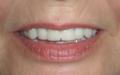 Cosmetic Denture Design, Teeth Whitening and Fangs by Speedy Denture Repairs LTD image 6