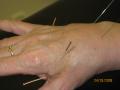 Hands-On Health Treatments (Chiropractic Chiropractor Physiotherapy Bristol) image 3