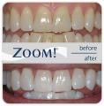 London Teeth Whitening image 2