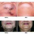 SimplyBeauty Mobile IPL/Laser Hair Removal Services image 3