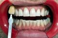 Sparkly Whites Laser Teeth Whitening Clinic image 4