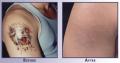 Tattoo Removal image 2