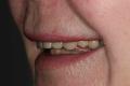 Tooth/Teeth Whitening Clinic Manchester CDental image 1
