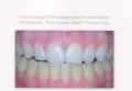 Tran-Quality Laser Teeth Whitening image 4