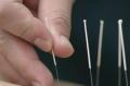 Barbican Acupuncture for Pain Relief, Sports Injury: London, EC2 image 7
