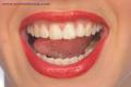 BLU LITE Teeth Whitening image 2