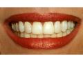 BLU LITE Teeth Whitening image 1