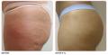 LipoSculpt image 7