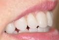 Burnside Dental Lab and Dental Practice - New Dentures - Urgent Denture Repairs image 2